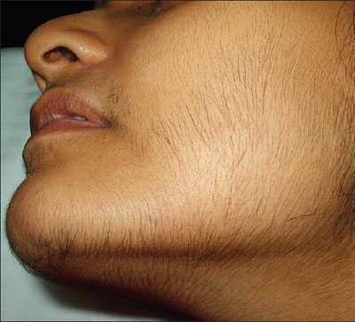  Jaipur Hirsutism Treatment